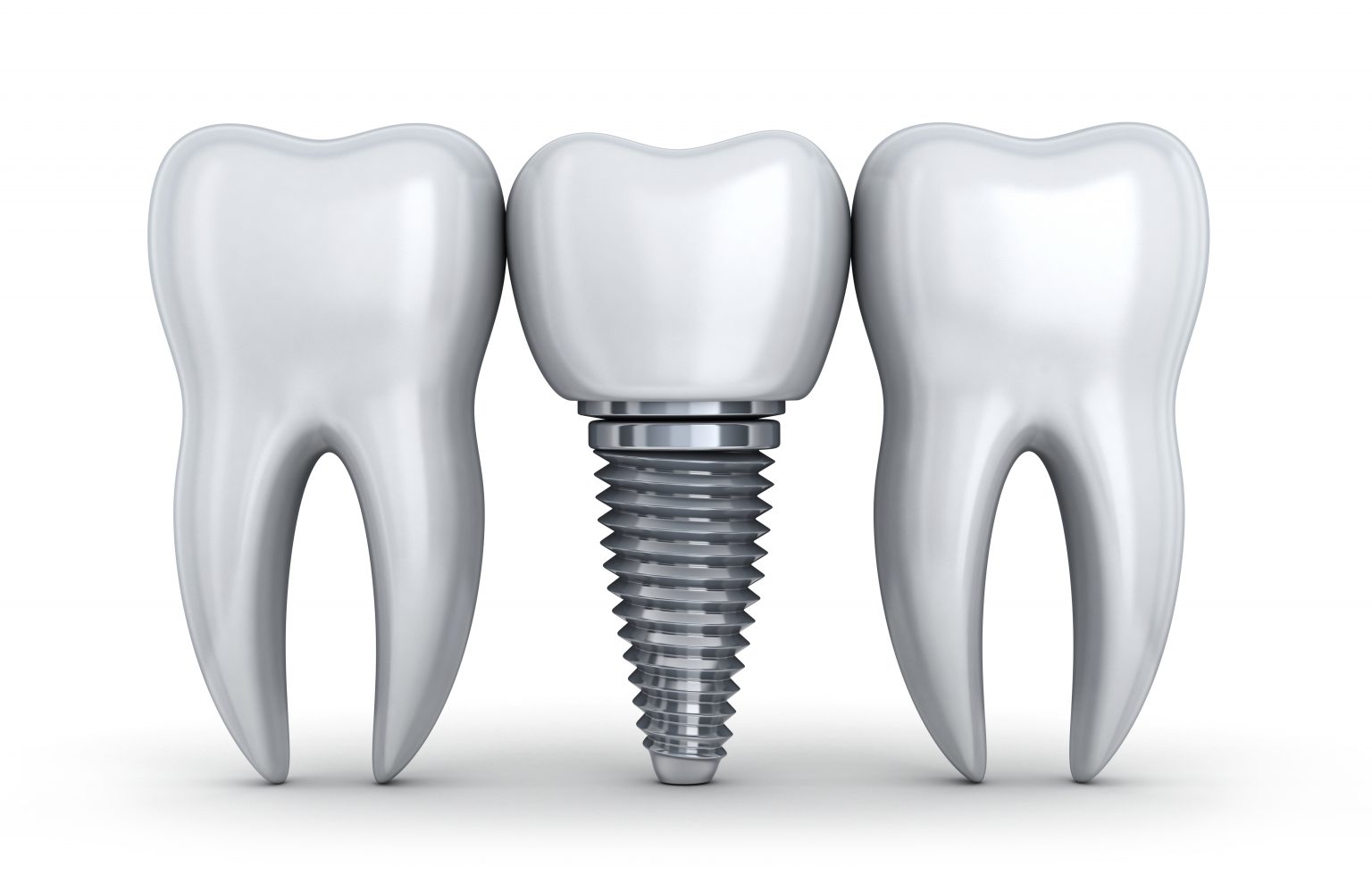 Illustration of a dental implant positioned between two natural teeth.