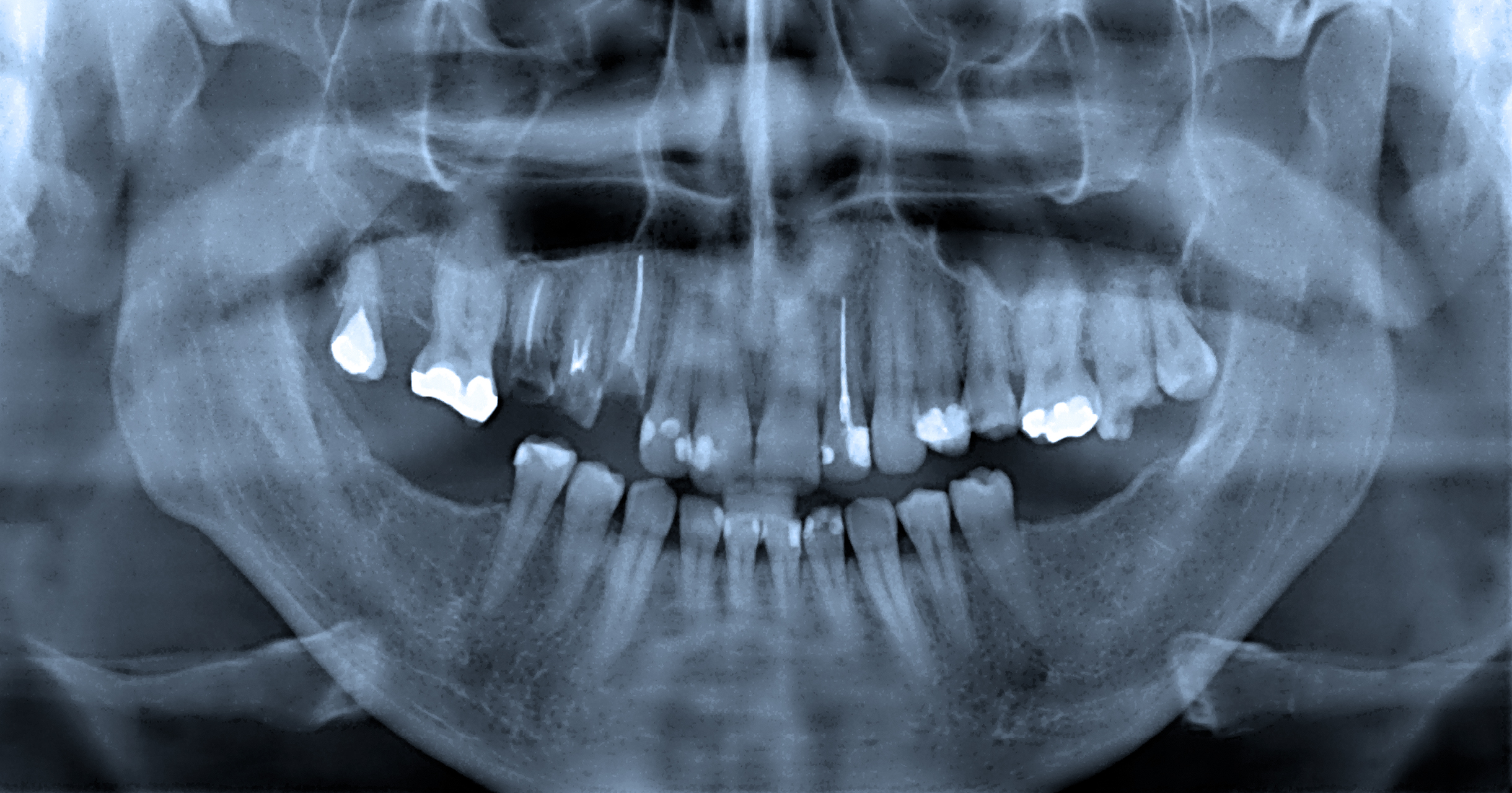 Fillings