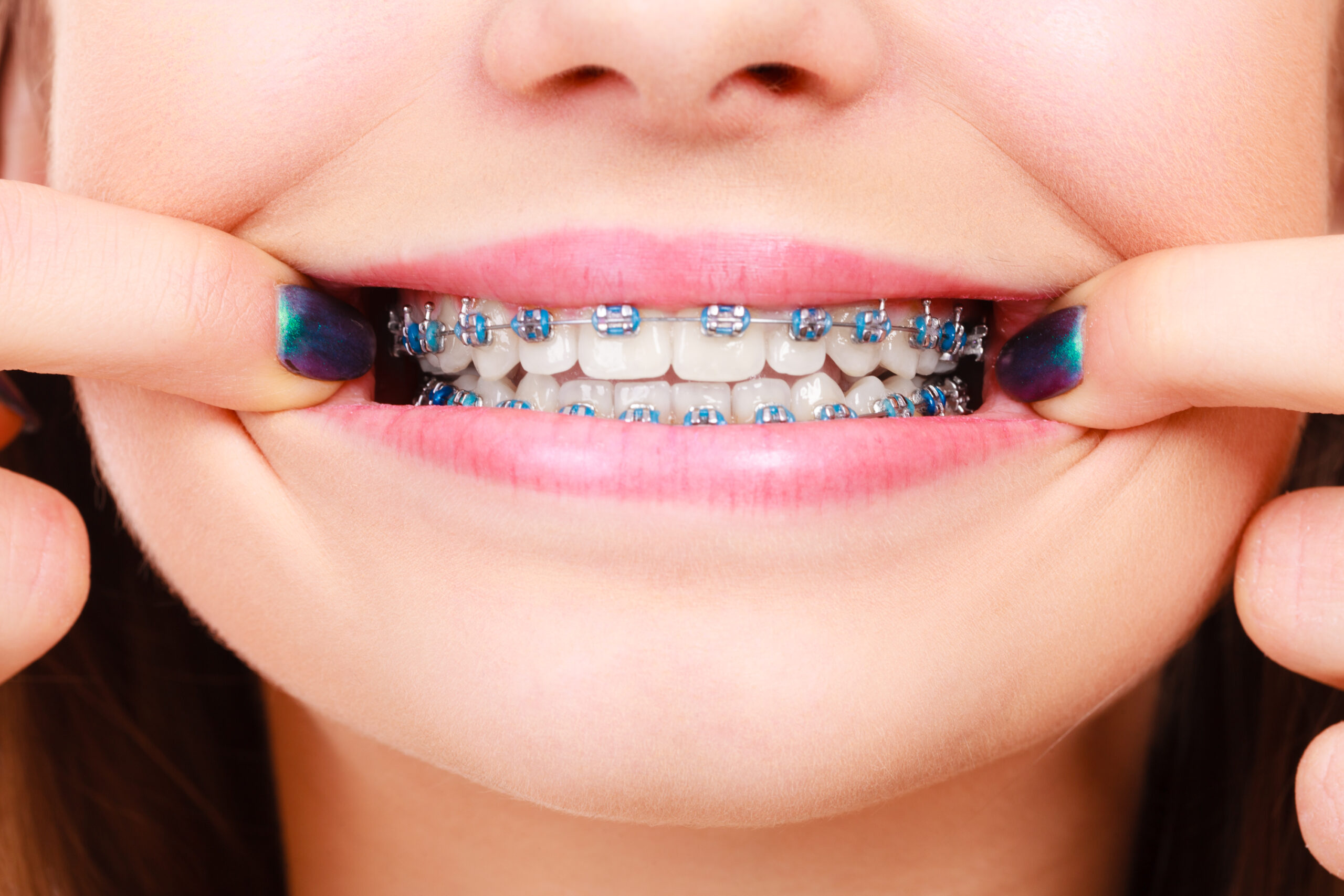 Child Orthodontics