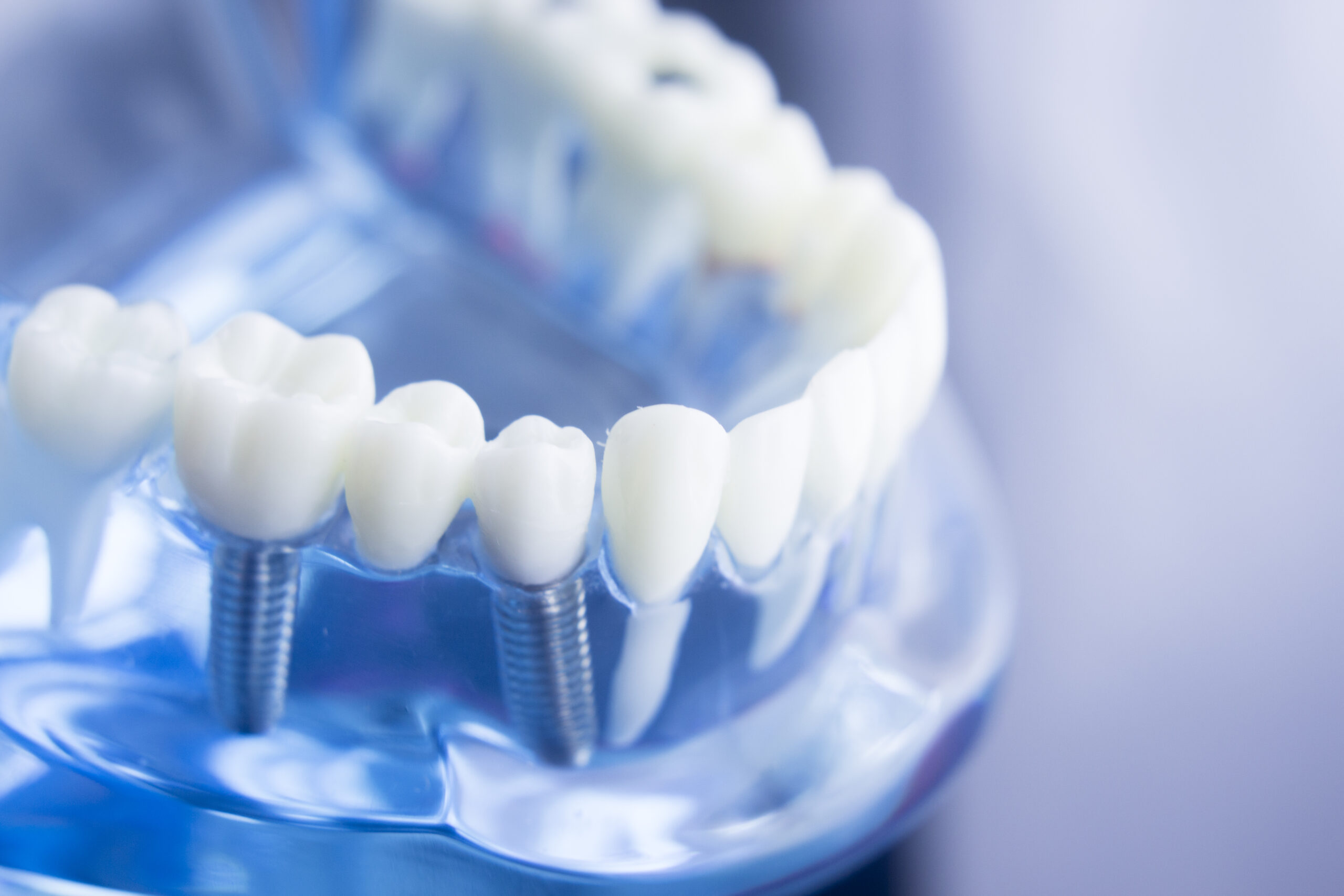 Close-up of a dental model displaying teeth and dental implants in a clear base.
