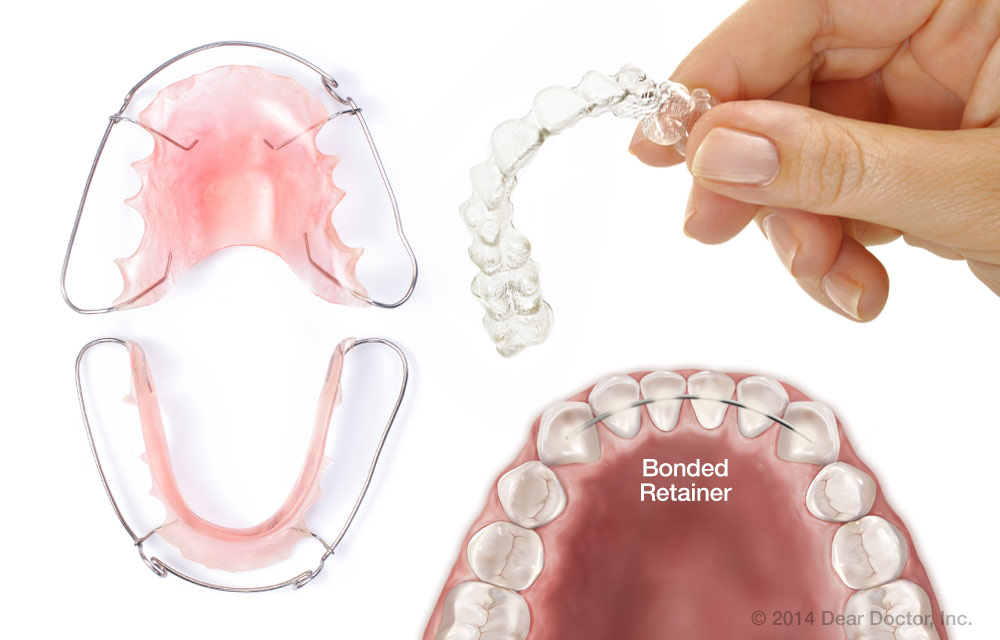Various types of dental retainers including a bonded retainer and removable options.