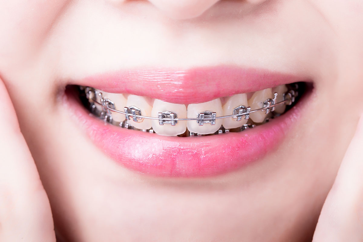 Close-up of a person's smile showing traditional metal braces on their teeth.